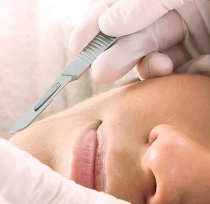 dermaplaning sada