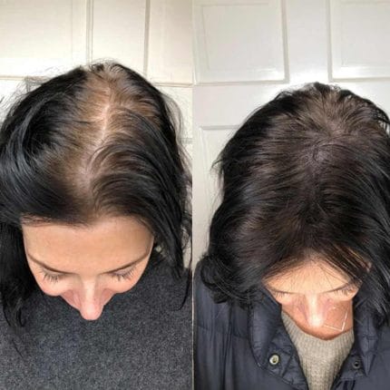 Mikropigmentácia pokožky hlavy je neinvazívne ošetrenie